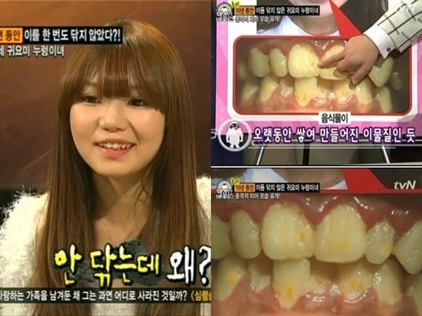 Cô gái xinh đẹp 10 năm không đánh răng nổi tiếng Hàn Quốc