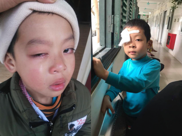 Lạng Sơn: Phụ huynh tố cáo cô giáo đánh trọng thương mắt con trai học lớp 1